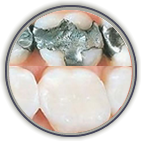 White Fillings
